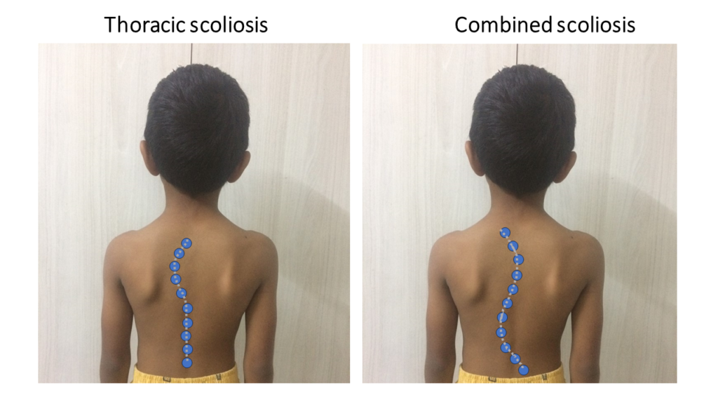 Model showing different types of scoliosis