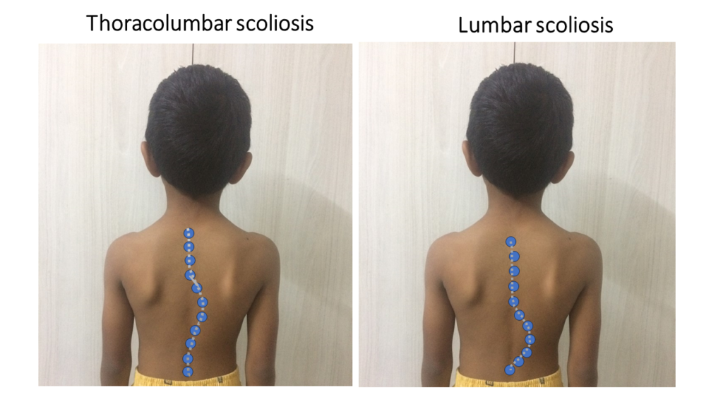 Picture of a model boy explaining different types of scoliosis