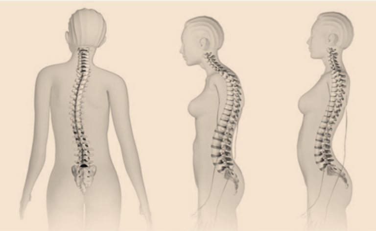 Lordosis